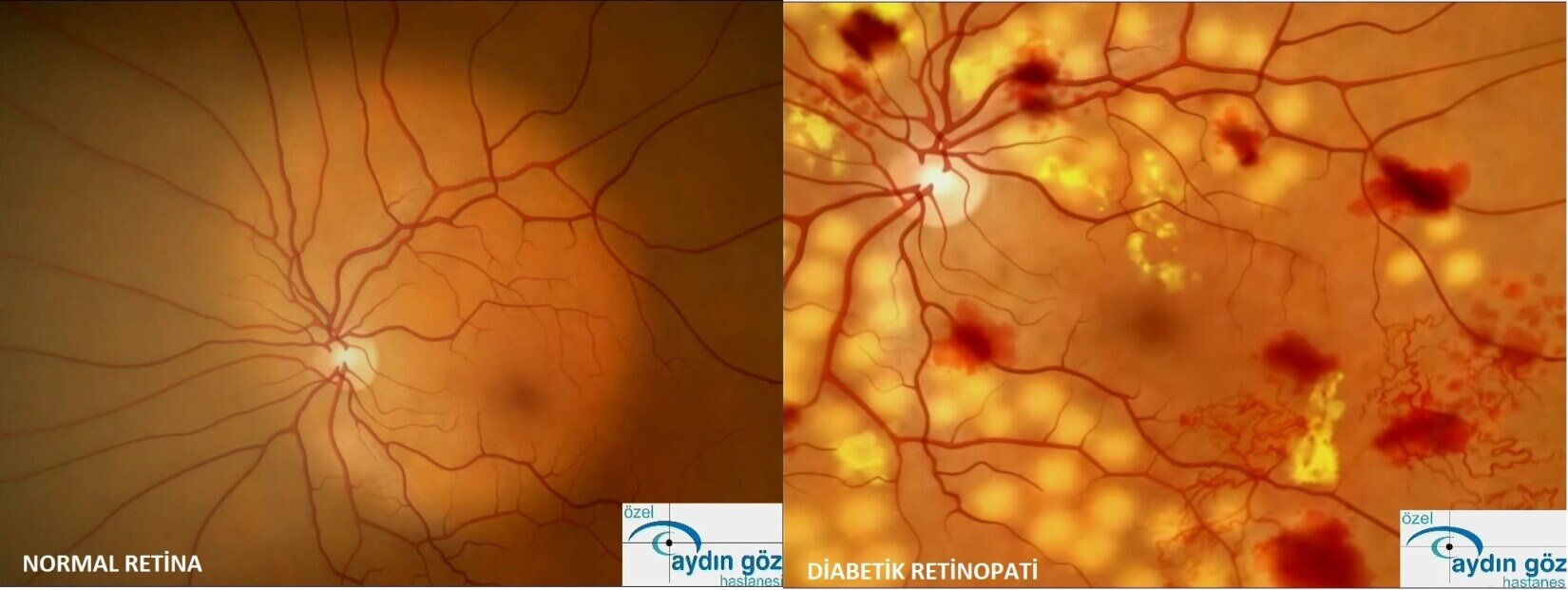 retina-hastaliklari-4
